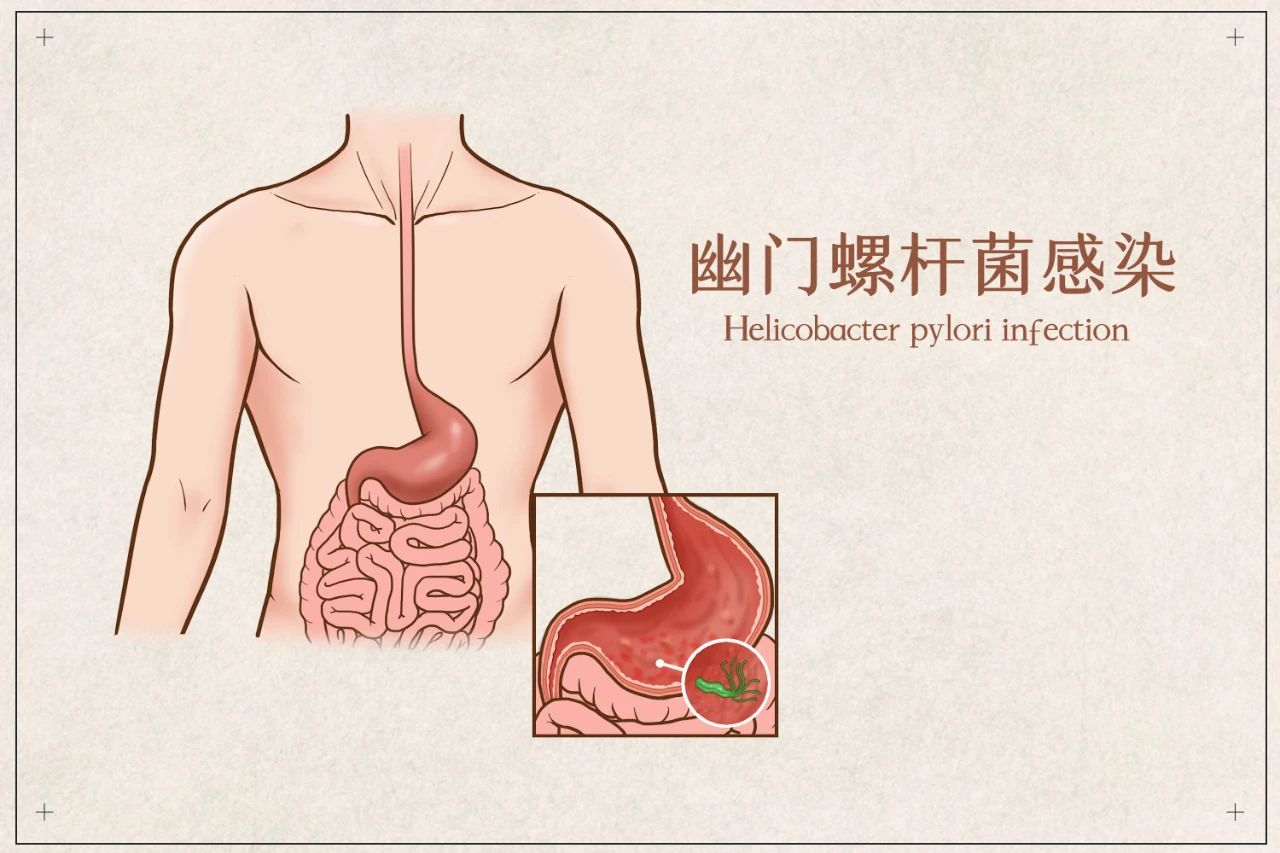 幽门菌1.jpg