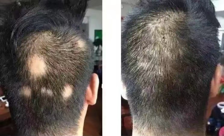 脱发2.jpg