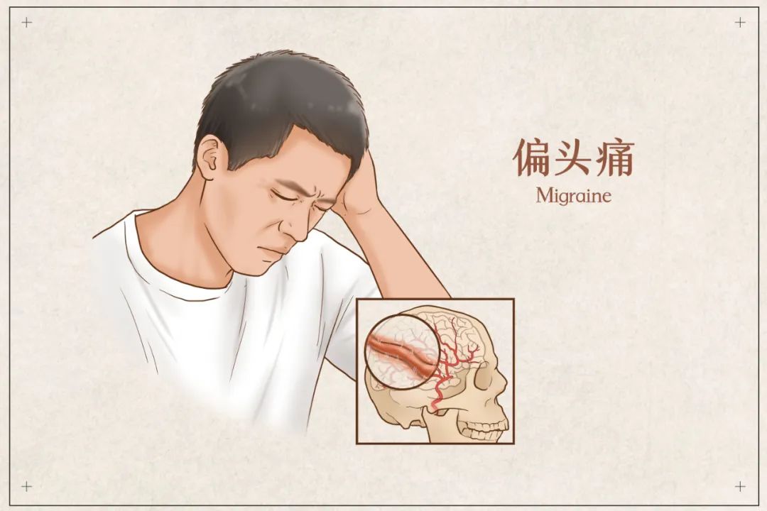 偏头痛1.jpg